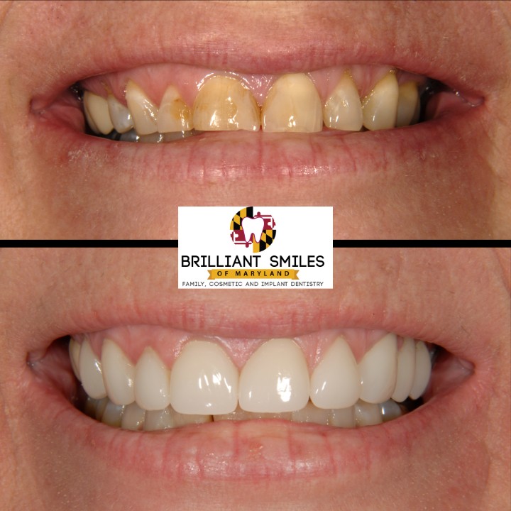 Before-and-after smile transformation at Brilliant Smiles of Maryland