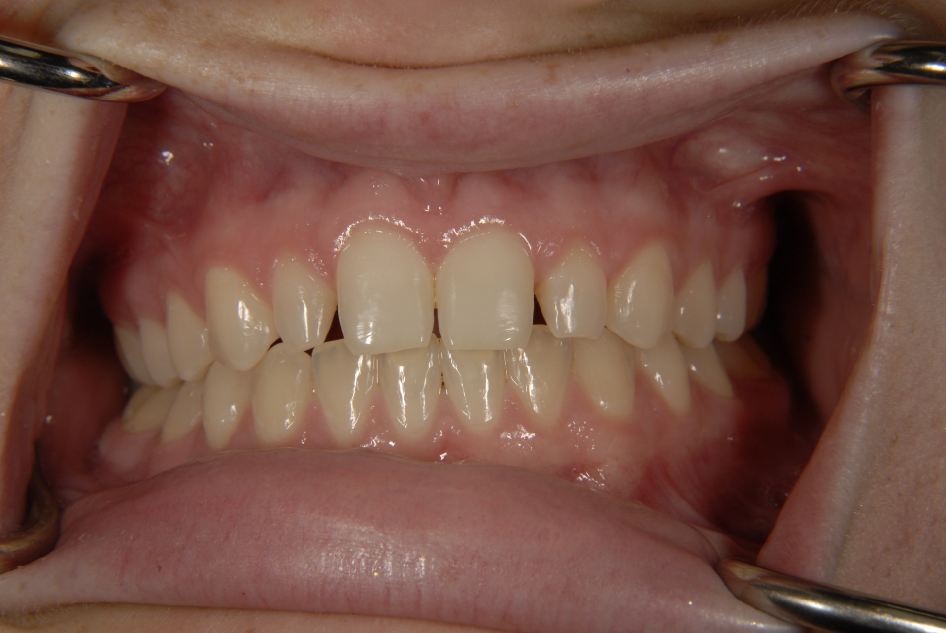 Patient smile result at Brilliant Smiles of Maryland