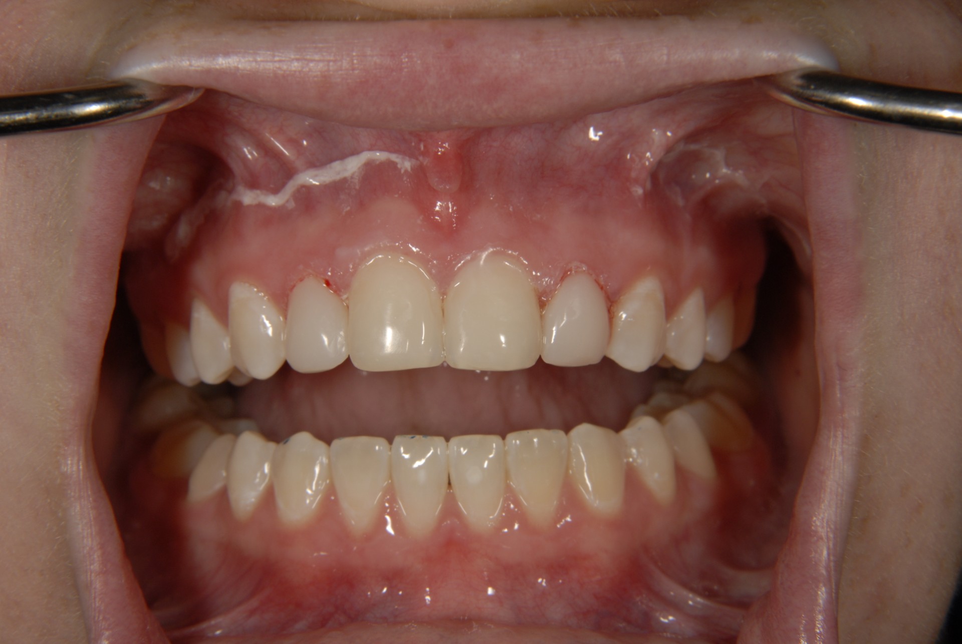 Patient smile result at Brilliant Smiles of Maryland