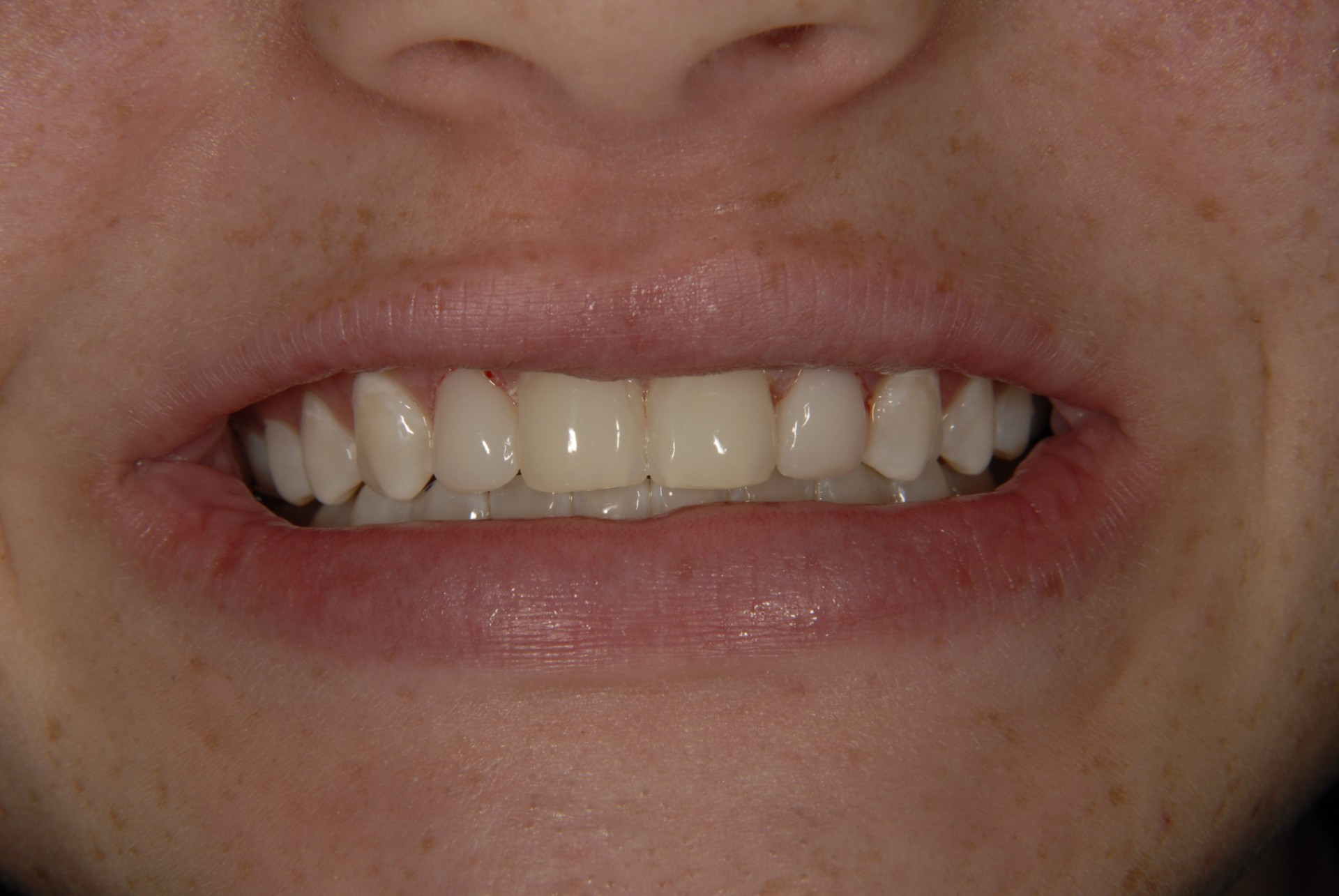 Patient smile result at Brilliant Smiles of Maryland