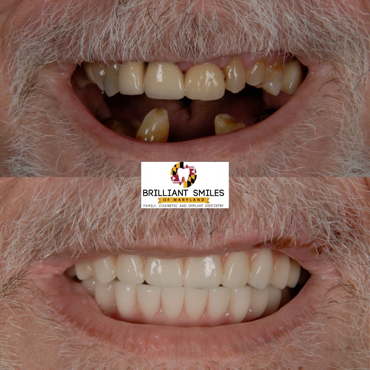 Before-and-after smile transformation at Brilliant Smiles of Maryland