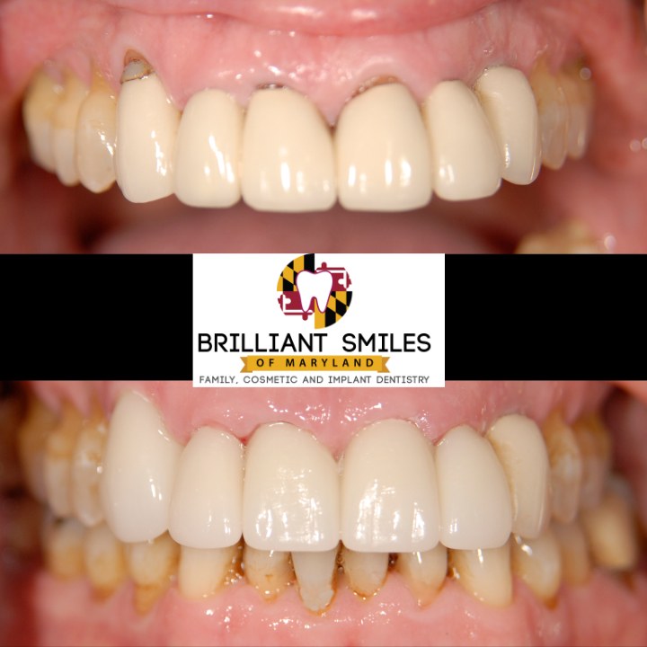 Before-and-after smile transformation at Brilliant Smiles of Maryland