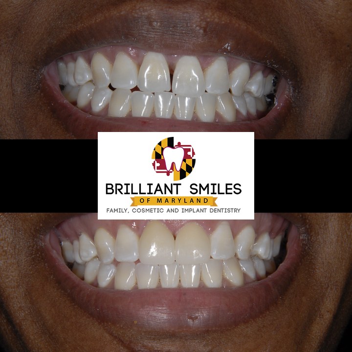Before-and-after smile transformation at Brilliant Smiles of Maryland