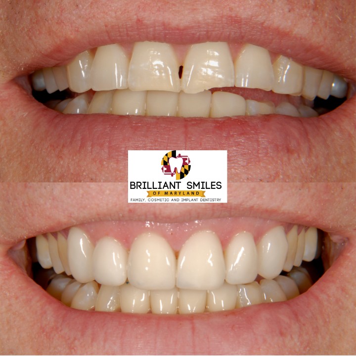 Before-and-after smile transformation at Brilliant Smiles of Maryland