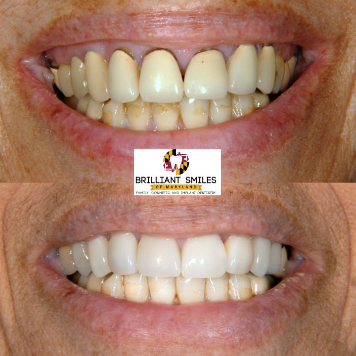 Before-and-after smile transformation at Brilliant Smiles of Maryland