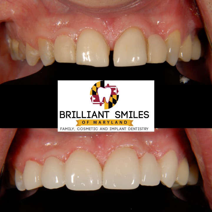 Before-and-after smile transformation at Brilliant Smiles of Maryland