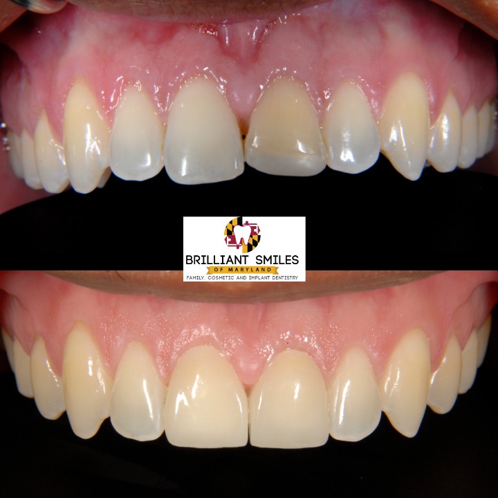 Before-and-after smile transformation at Brilliant Smiles of Maryland