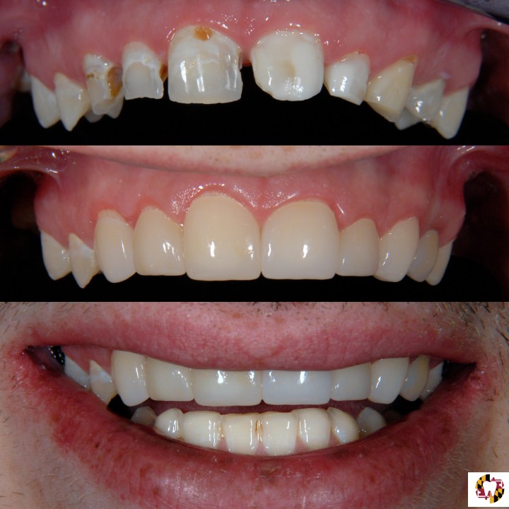 Before-and-after smile transformation at Brilliant Smiles of Maryland