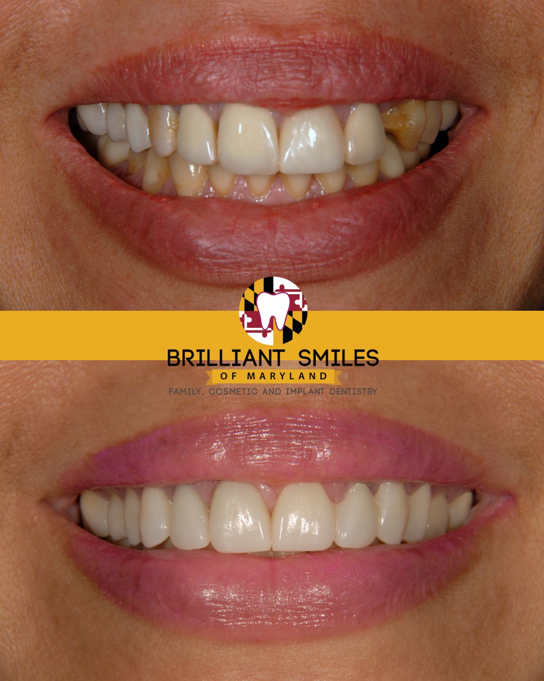 Before-and-after smile transformation at Brilliant Smiles of Maryland