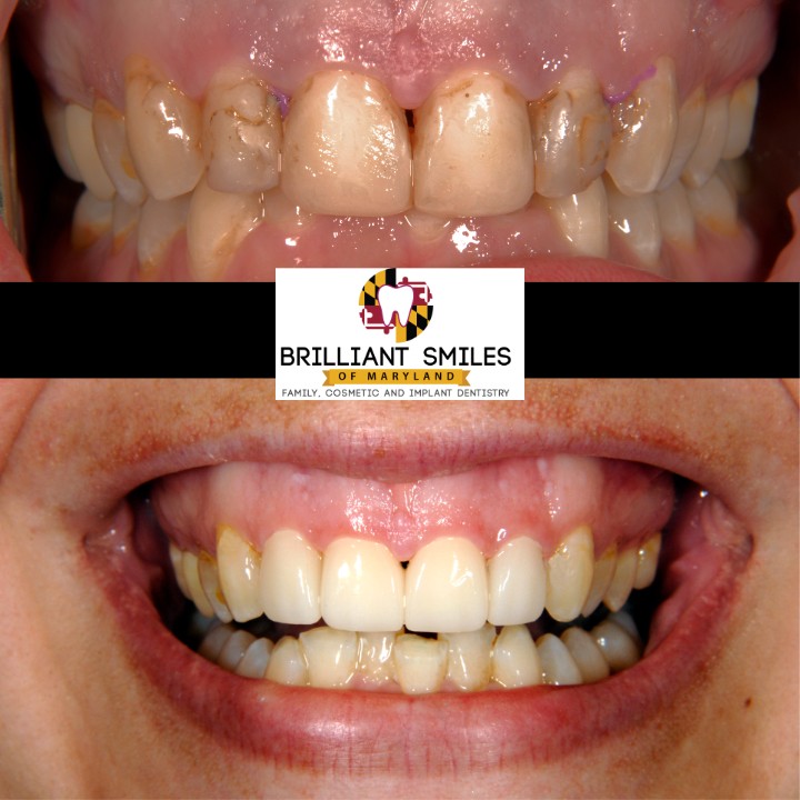 Before-and-after smile transformation at Brilliant Smiles of Maryland