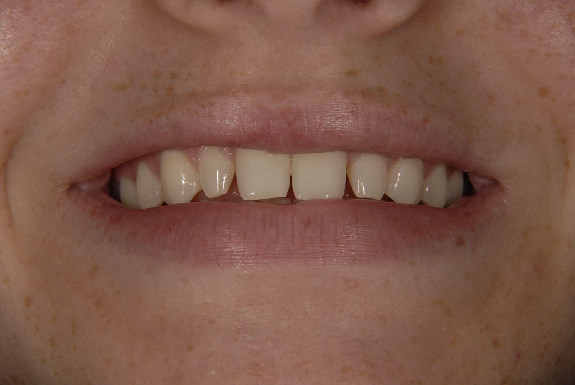 Patient smile result at Brilliant Smiles of Maryland